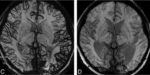 Vpravo trombóza sinus transversus vlevo s dilatací žil v levé hemisféře. Vpravo normalizace po rekanalizaci trombózy.