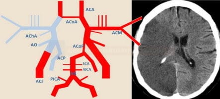Okluze distální ACI vpravo vedla u fetálního typu zásobení ACP k infarktu v povodí ACM i ACP
