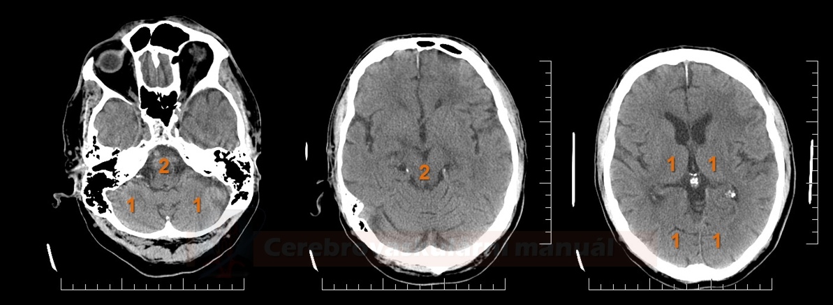 PC-ASPECTS (The posterior circulation Acute Stroke Prognosis Early CT score)