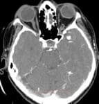 CTA - aneuryzma ACM vlevo s intrasakulárním trombem