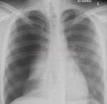 RTG - pneumothorax po kanylaci v.scl. vpravo