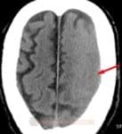 Edém levé hemisféry na CT v důsledku hyperperfúzního syndromu