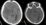 Mozkový absces otogenní původu (vlevo nativní CT, vpravo po podání k.l.)