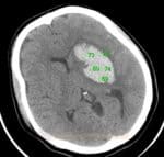 CT mozku - denzita hematomu se v akutním stadiu pohybuje okolo 70-80 HU.