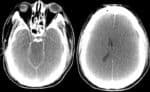 Difúzní edém mozku v důsledku hypoperfúze během operace v ECC