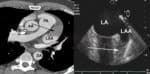 CT a TEE - trombus v oušku levé síně