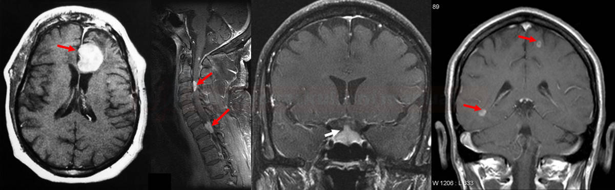 Neurosarkoidóza v MR obraze