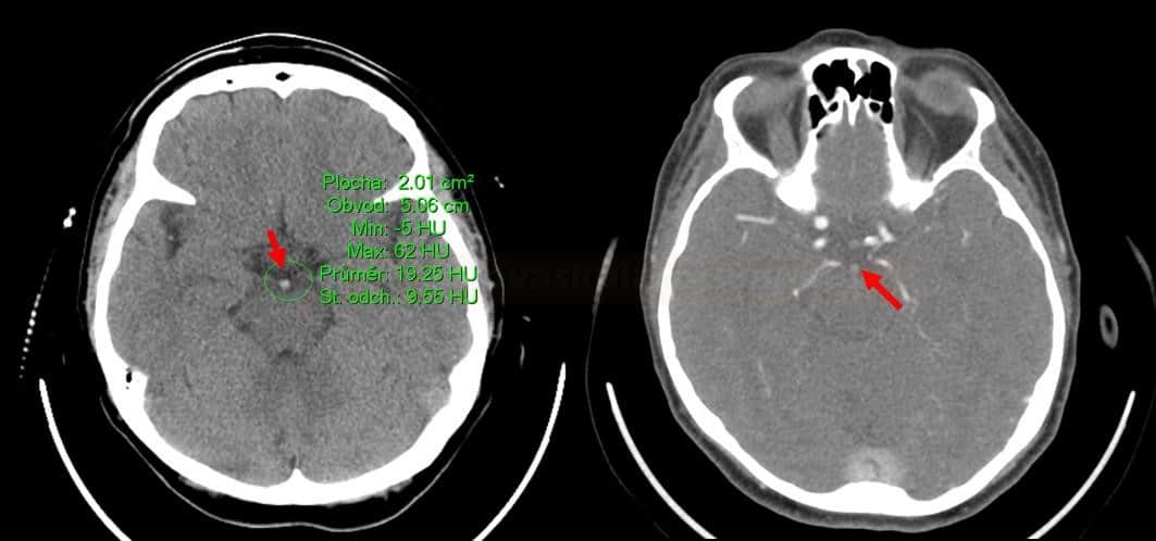 Okluze top basilaris s opakovanými TIA. Při vyšetření bez klinického deficitu. Vlevo nativní CT s dense artery sign (62HU), vpravo CTA