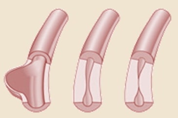 Takayasuova arteritida