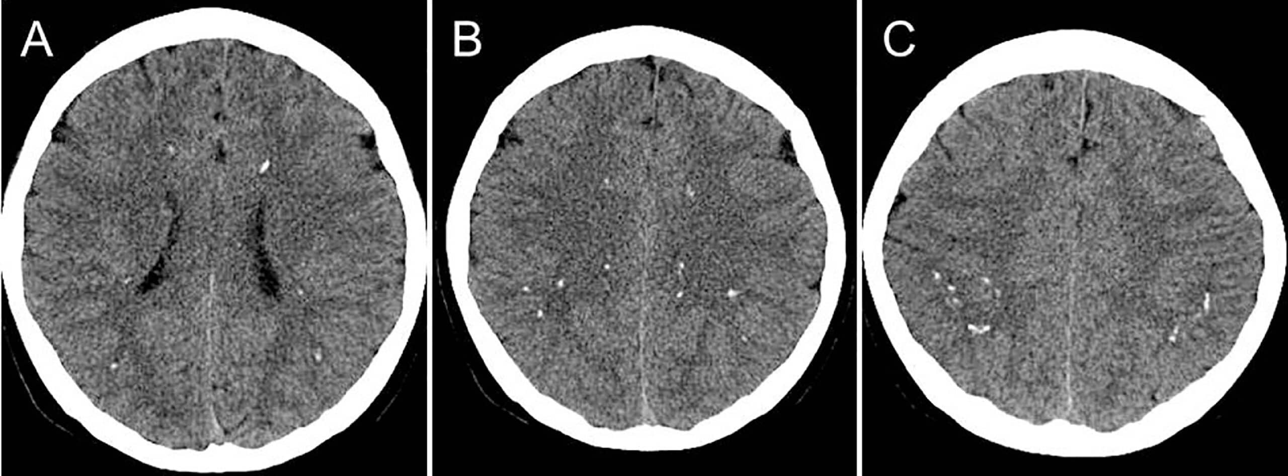 CT s drobnými kalcifikacemi u Adult-onset leukoencephalopathy with axonal spheroids and pigmented glia (ALSP)