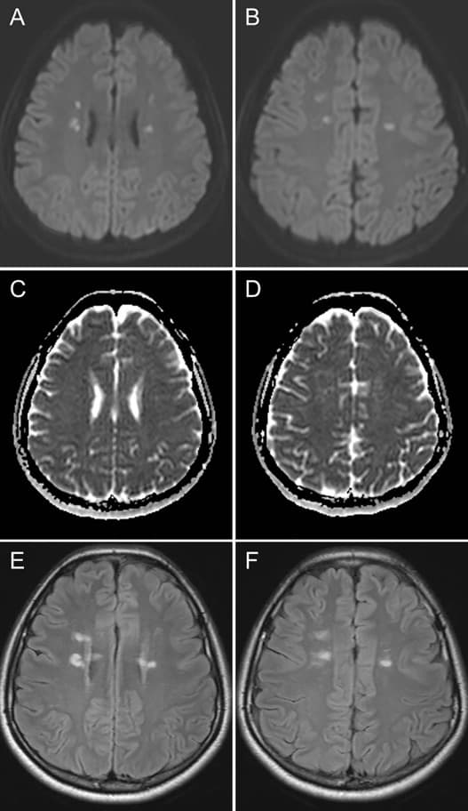MR - Adult-onset leukoencephalopathy with axonal spheroids and pigmented glia (ALSP)