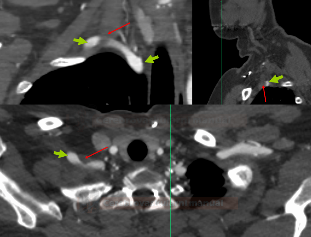 CT angiografie u pacientky s neurogenním TOS vpravo (zelená šipka - a.subclavia, červená šipka - m.scalenus anterior