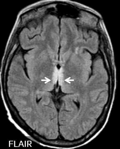 Wernickeho encefalopatie - postižení thalamu na MR FLAIR