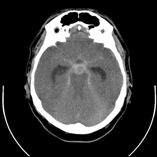 Nativní CT - subarachnoidální krvácení v důsledku ruptury aneuryzmatu na vrcholu a.basilaris