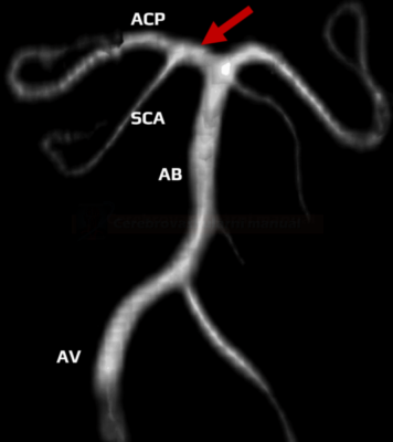 Společný odstup ACP a SCA na MR angiografii