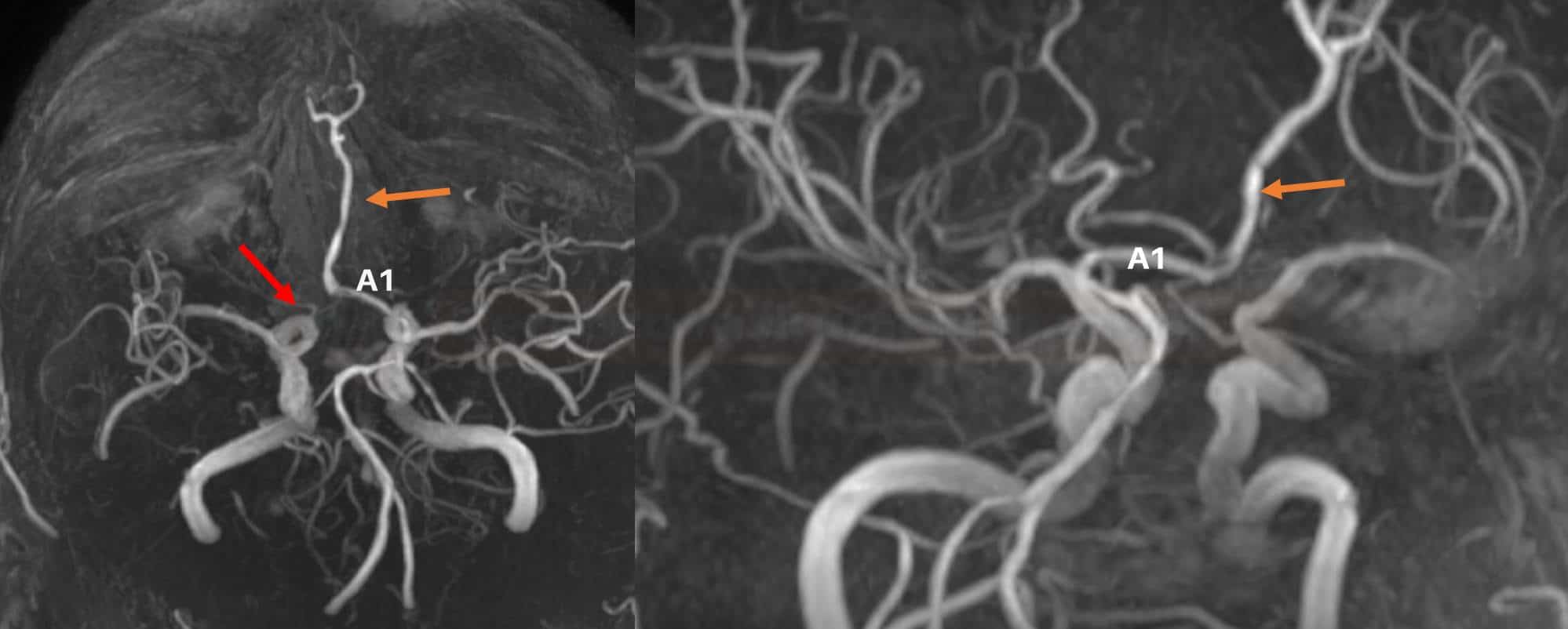 A. cerebri anterior azygos a hypoplázie či aplázie A1 úseku ACA vpravo