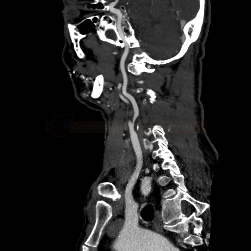 Stenóza a.carotis interna na CT angiografii