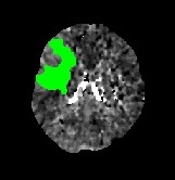 CT perfúze (zeleně zobrazena oblast s Tmax > 6s)