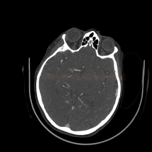 Okluze M2 úseku ACM vpravo na CT angiografii