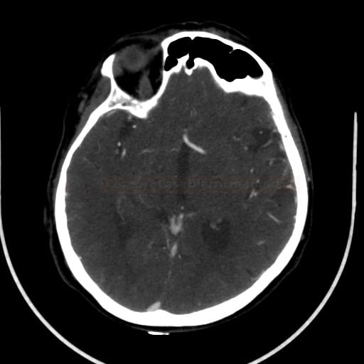 A.cerebri anterior azygos a hypoplazie A1 úseku ACA dx na CTA