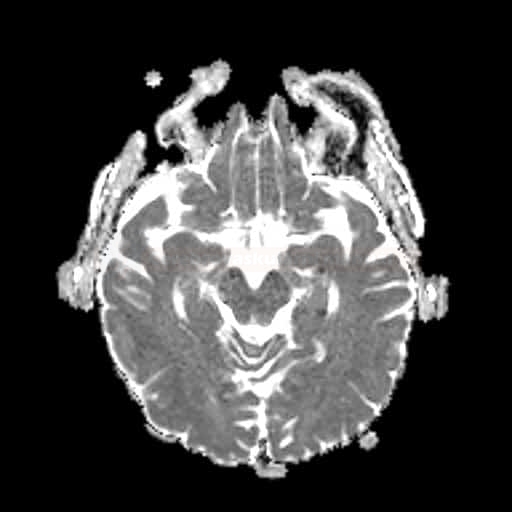 TGA syndrom na podkladě ischemie v levém hippocampu (MR ADC)