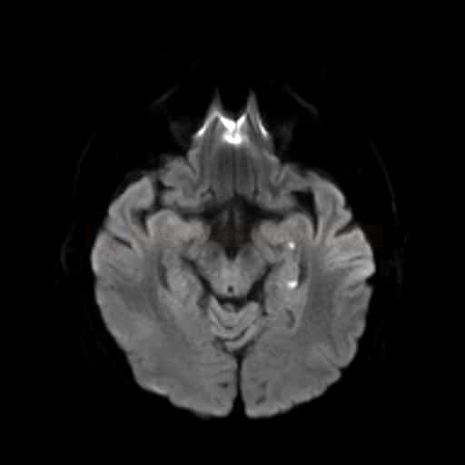 TGA syndrom na podkladě ischemie v hippocampu (MR DWI)