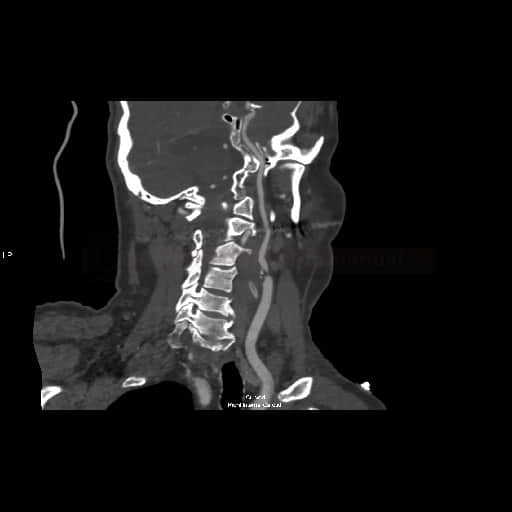 Těsná stenóza ACI dx na CT angiografii