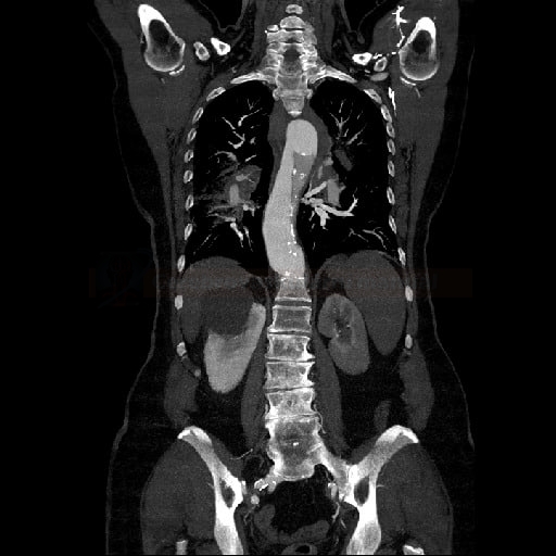 Disekce aorty - typ A