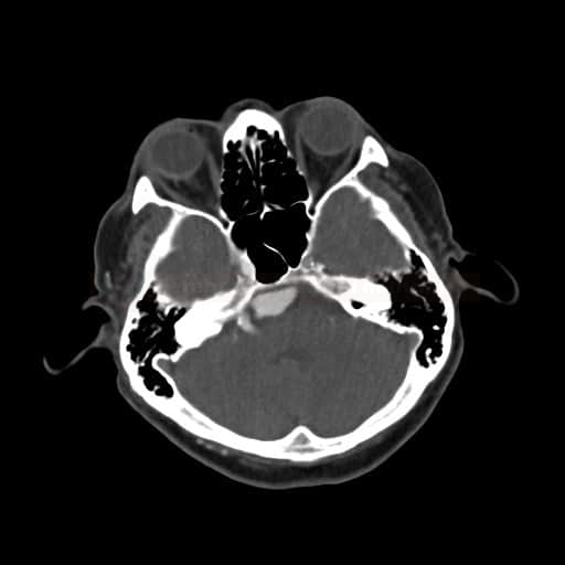 Fusiformní aneuryzma na a.basilaris (CTA)