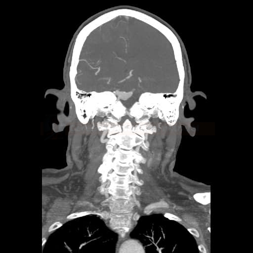 Fusiformní aneuryzma na a.basilaris (CTA rekonstrukce)
