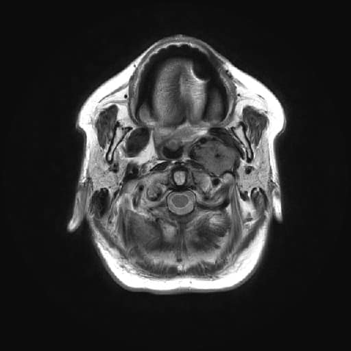 Tumor glomus vagale na MR (T2 axiální snímky)