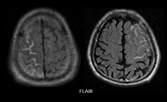Hyperperfůzní syndrom se sycením mening na postkontrastním MR