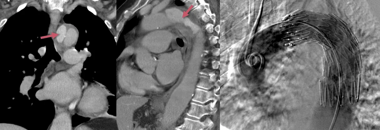 Disekce aorty (typ B) řešená stentgraftem