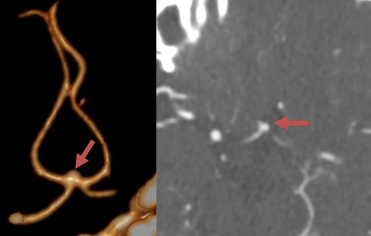 Vakovité (sakulární) aneuryzma na ACoA (CTA)