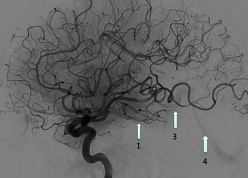 Early Venous Filling (EVF) following recanalization of M1 occlusion (Elands, 2021)