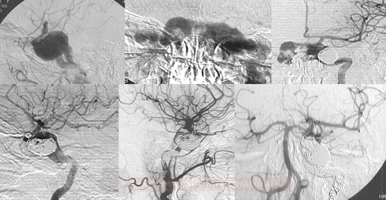 Okluze přímé CCF (vzniklé rupturou aneuryzmatu ACI do sinus cavernosus) postupnou embolizací aneurzymatu a následně celé ACI
